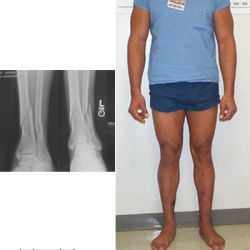 patient with tibial fracture