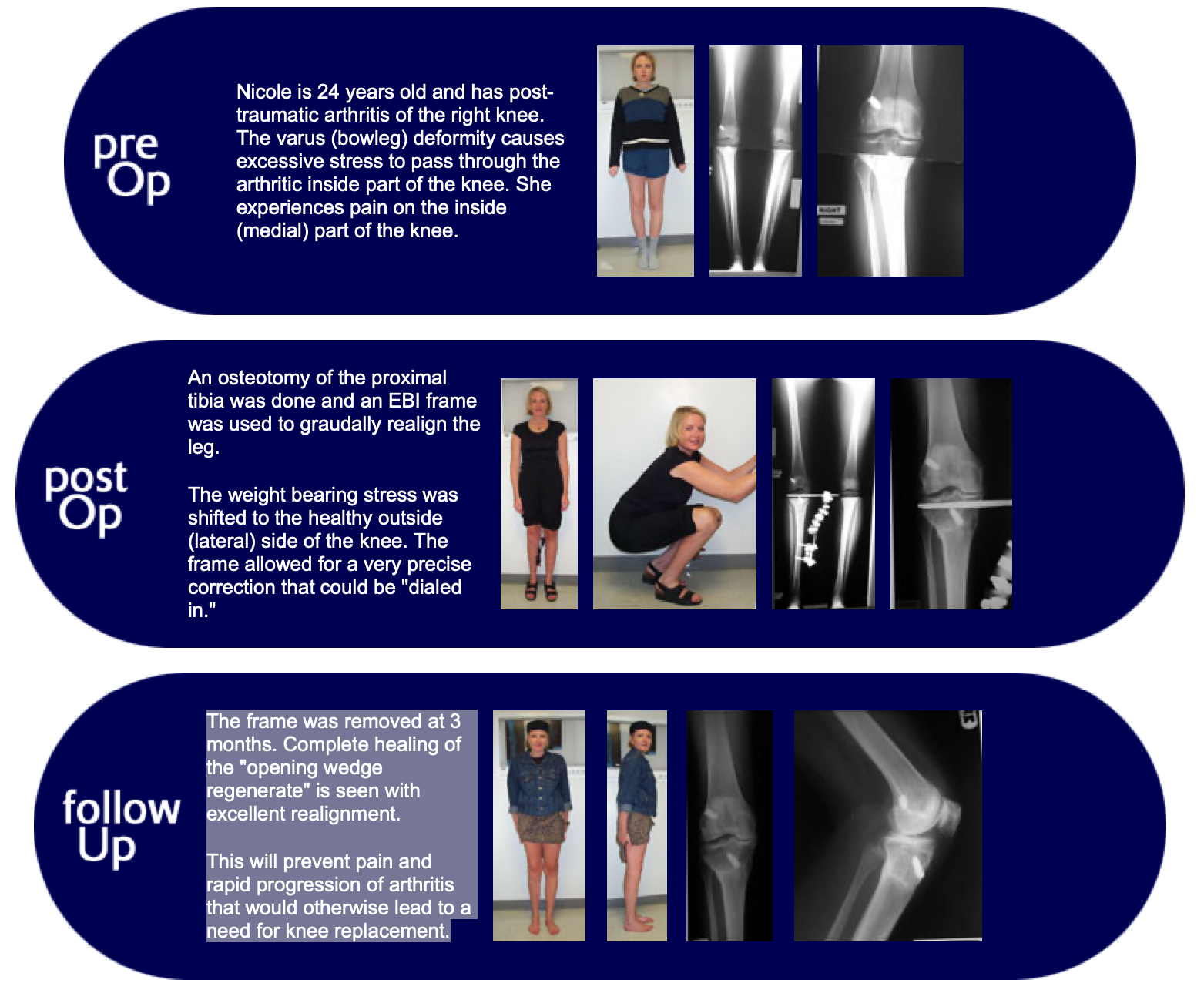 High Tibial Osteotomy For Knee Realignment Limb Lengthening