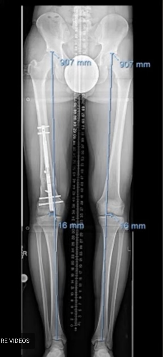 Precice Internal Lengthening Nail Case Histories Limb Lengthening 7265