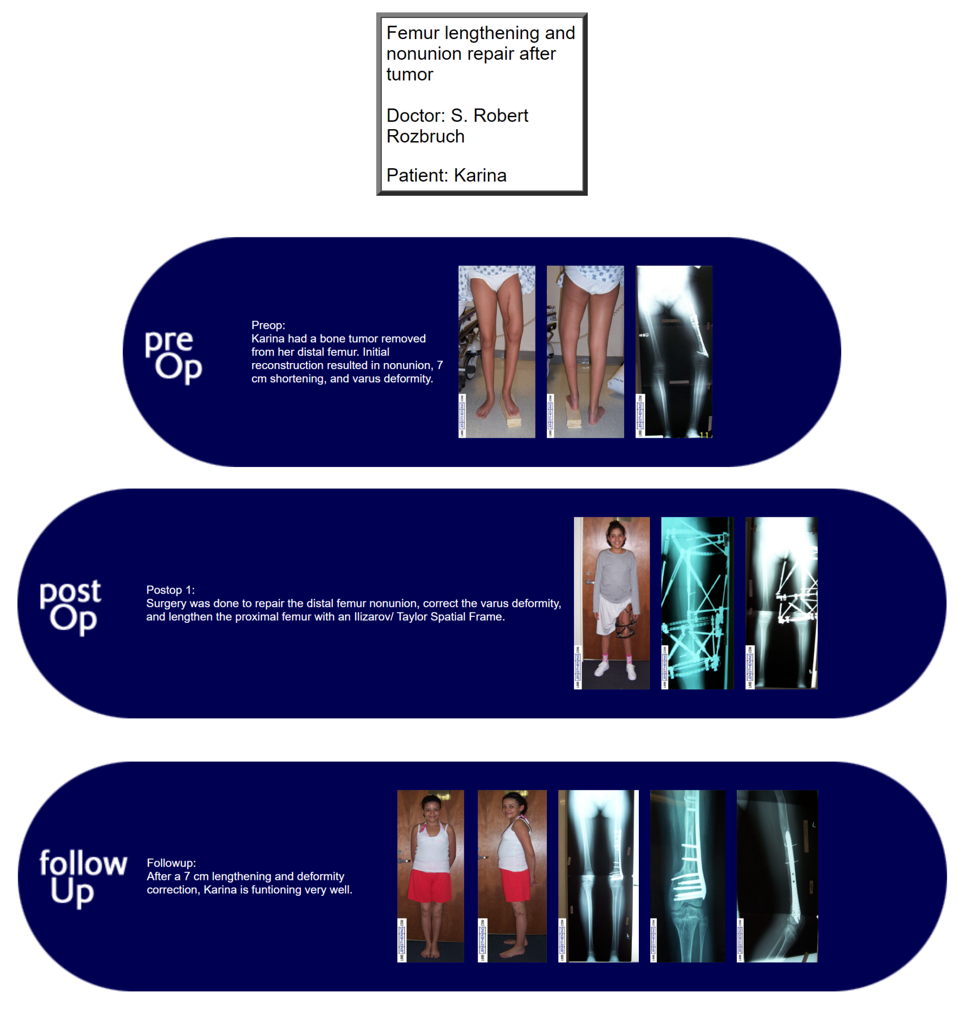 Case History Femur Lengthening And Nonunion Repair After Tumor