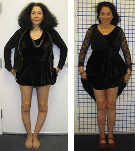 Bowlegs Patient Before and After