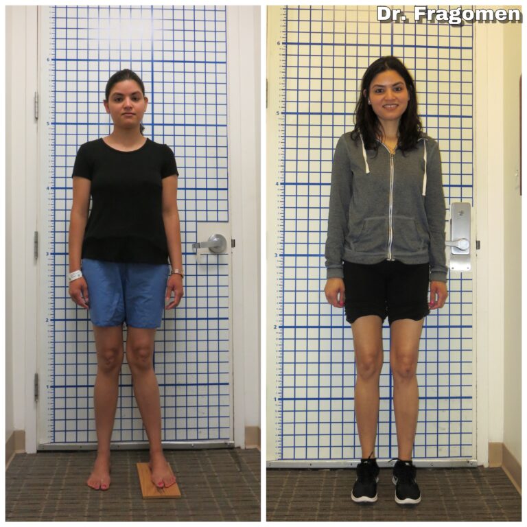 Knock Knee Before and After - Limb Lengthening