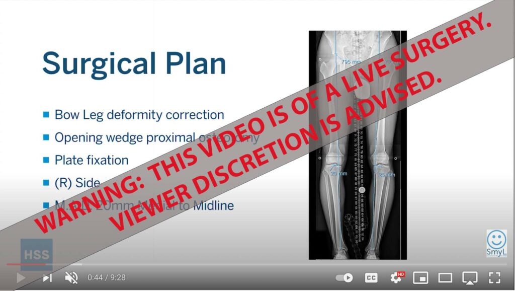 live video still of high tibial osteotomy to correct bowleg deformity