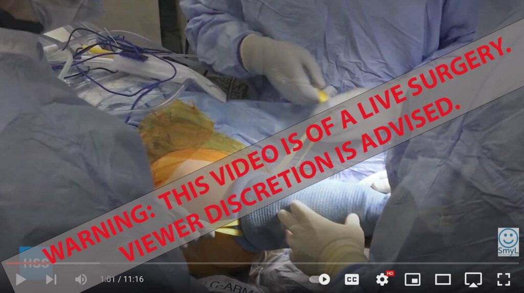 live video of osseointegration surgery
