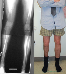 Femur Lengthening Before and After Photos – Limb Lengthening