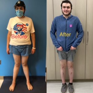 Knock Knee Deformity Before and After Photos – Limb Lengthening