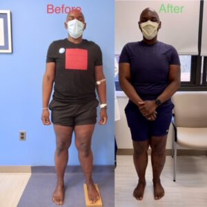 Knock Knee Deformity Before and After Photos – Limb Lengthening