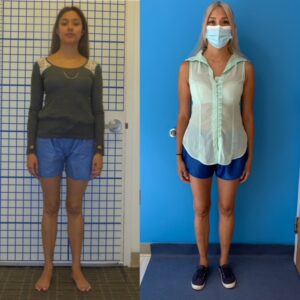 Knock Knee Deformity Before and After Photos – Limb Lengthening