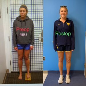 Knock Knee Deformity Before and After Photos – Limb Lengthening