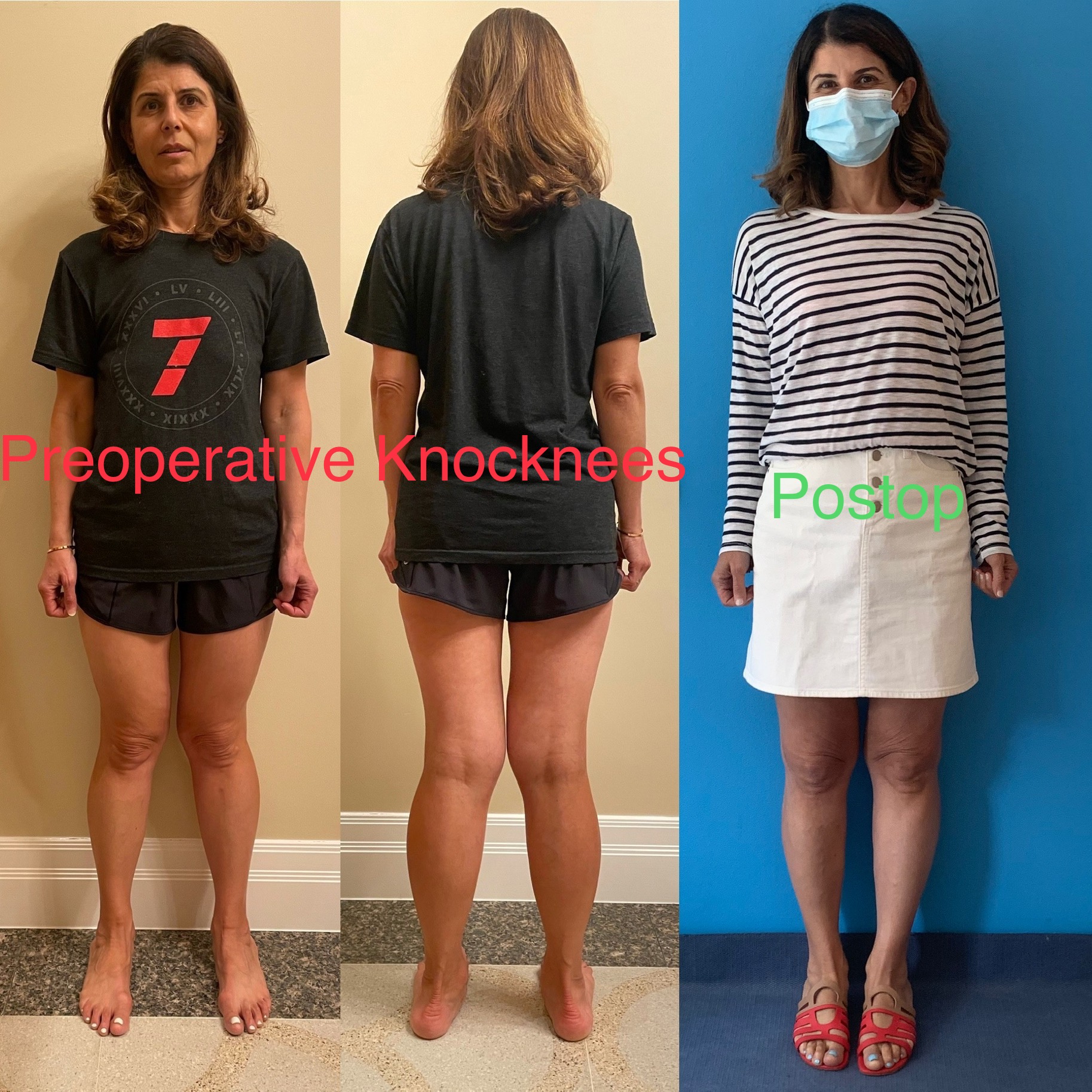 Knock Knee Deformity Before and After Photos - Limb Lengthening