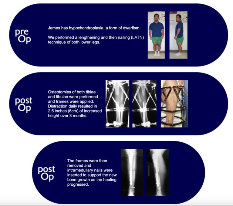 Stature Lengthening for Hypochondroplasia – Limb Lengthening