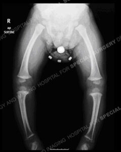 Bowleg Overview – Limb Lengthening