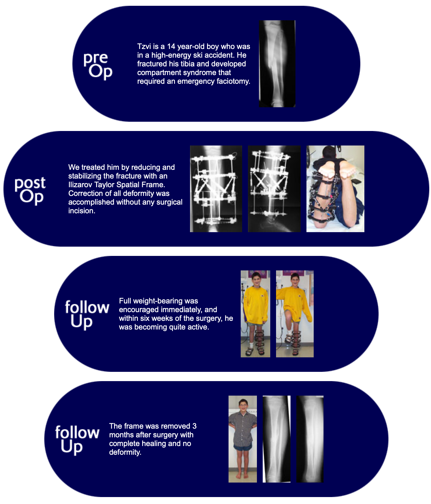 Complex Tibia Fracture In Child Limb Lengthening