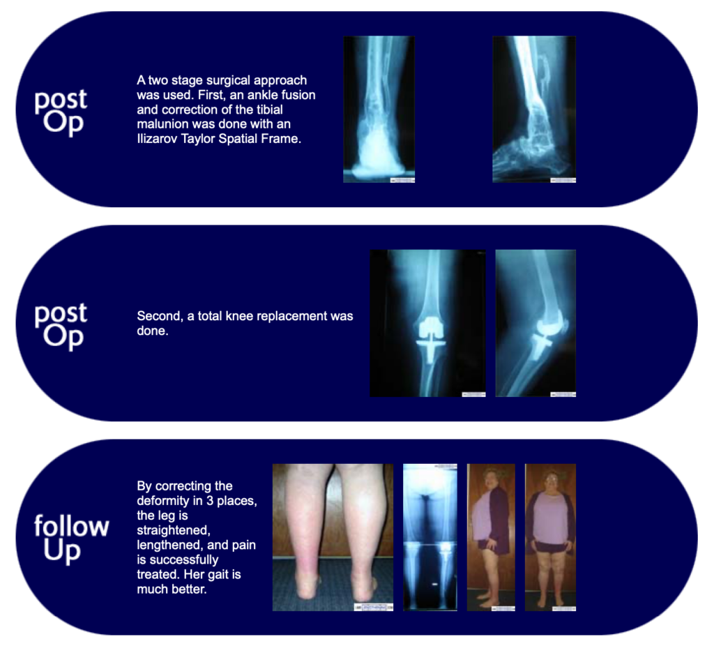 Correction of Knock Knee Deformity – Limb Lengthening