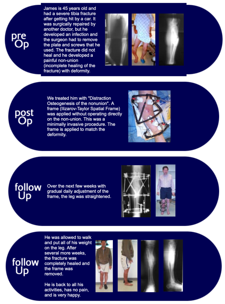 Tibial Non-Union Patient