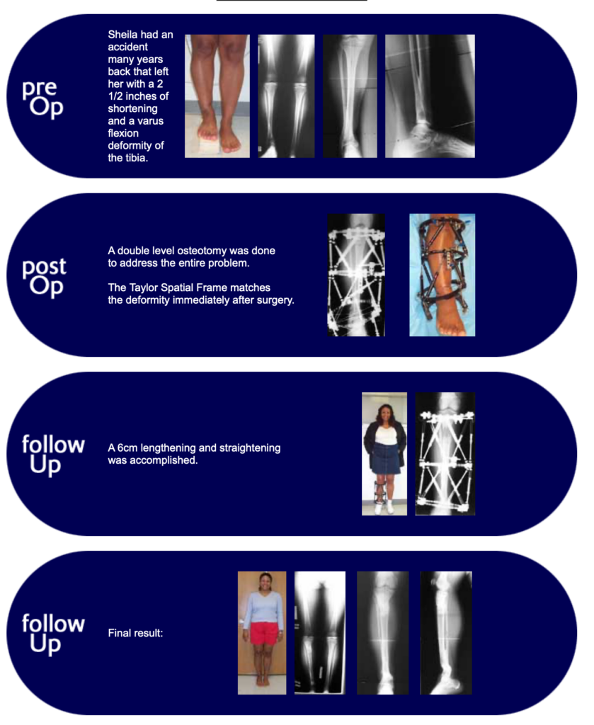 Sheila, double osteotomy patient