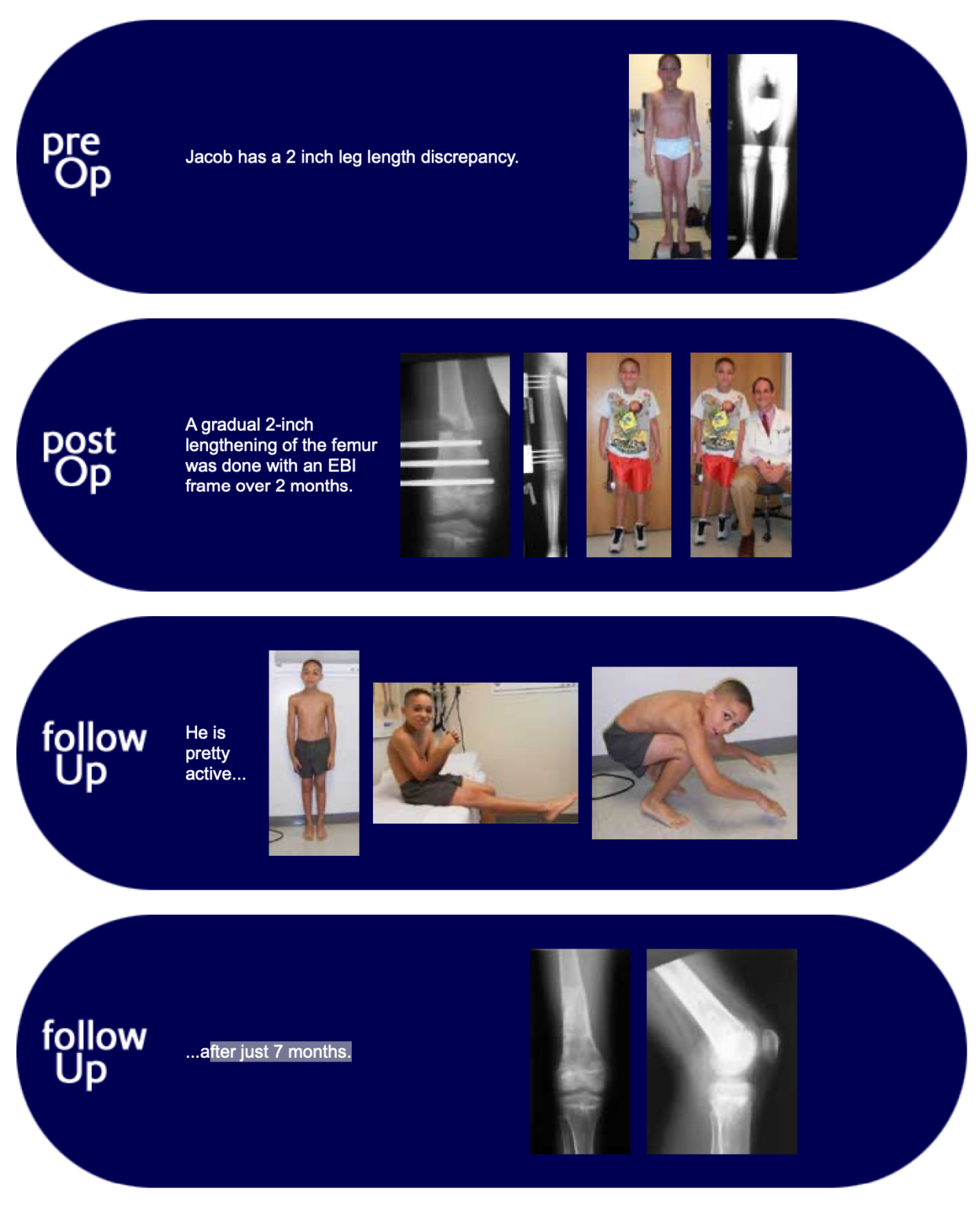 Pediatric Femoral Lengthening – Limb Lengthening