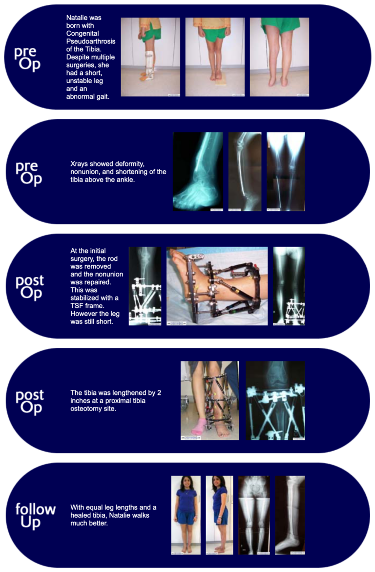 Limb Salvage Reconstruction of Congenital Pseudoarthrosis – Limb ...