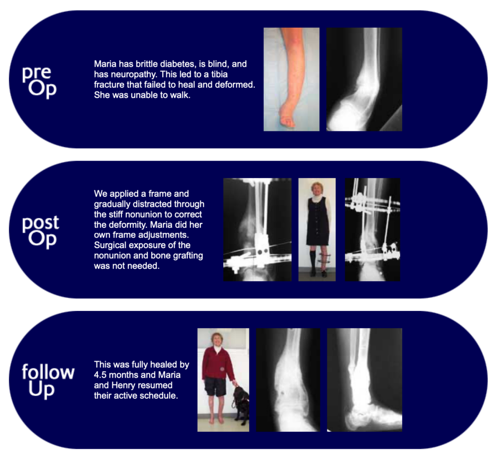 Maria, Brittle Diabetes Patient with Tibial Non-Union