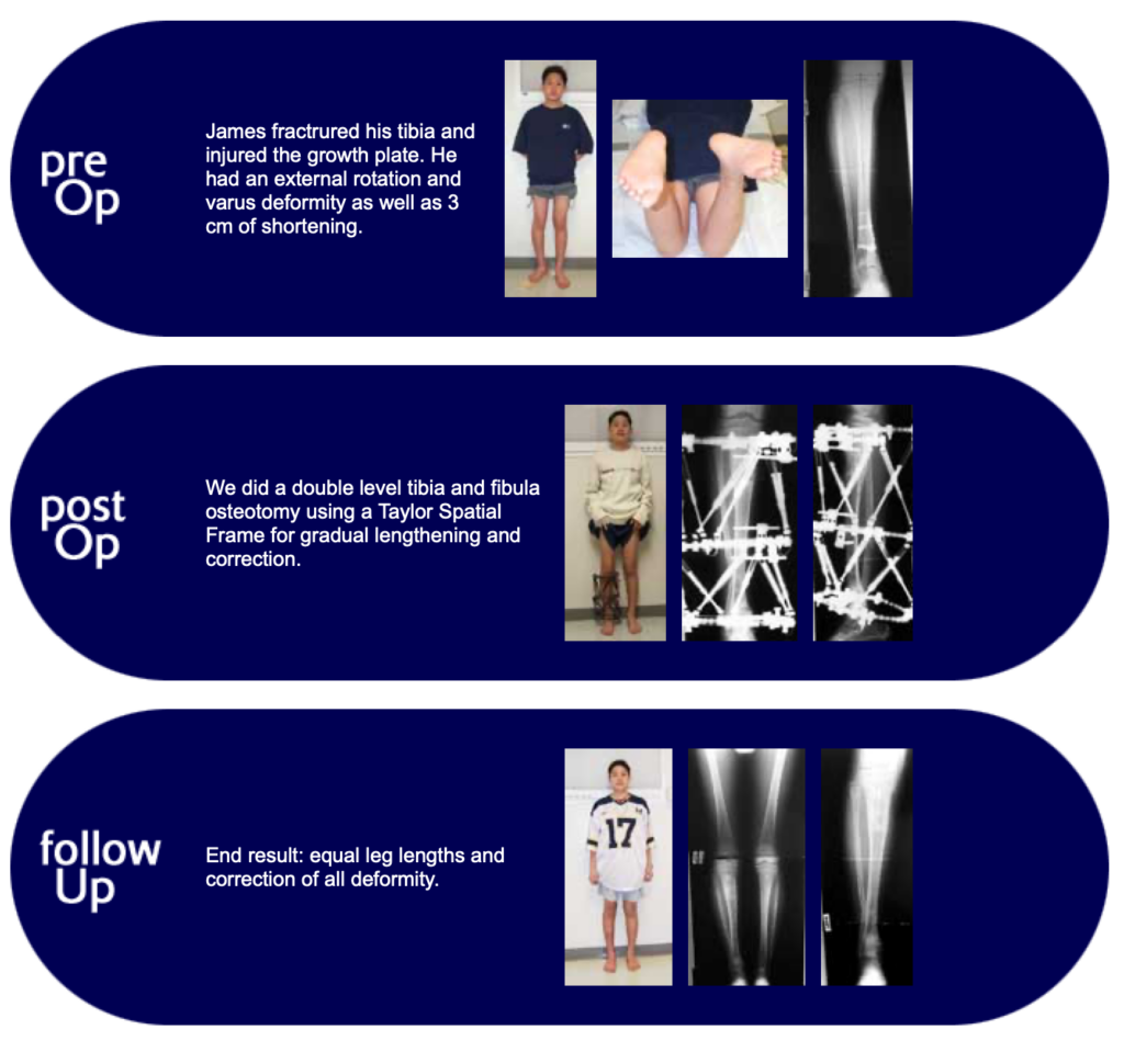 James, patient with growth plate injury