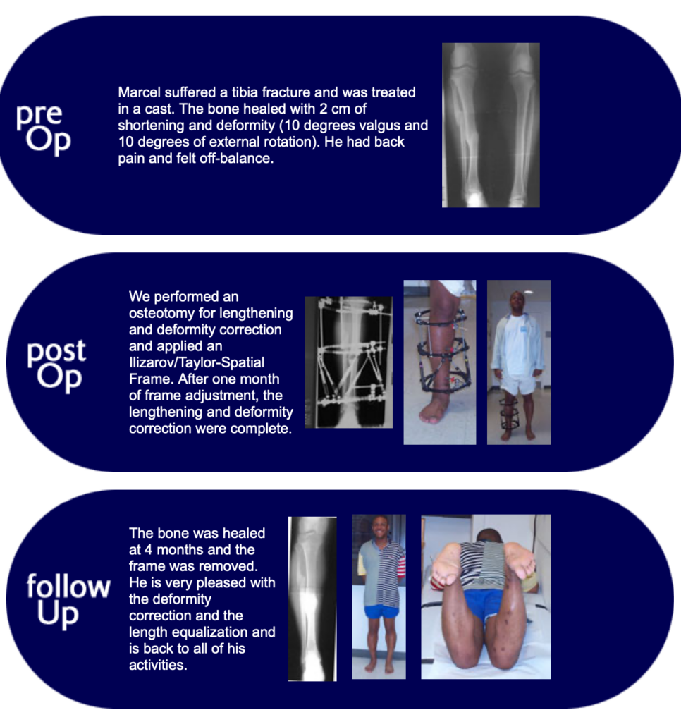 Marcel, Tibial Deformity Correction Patient